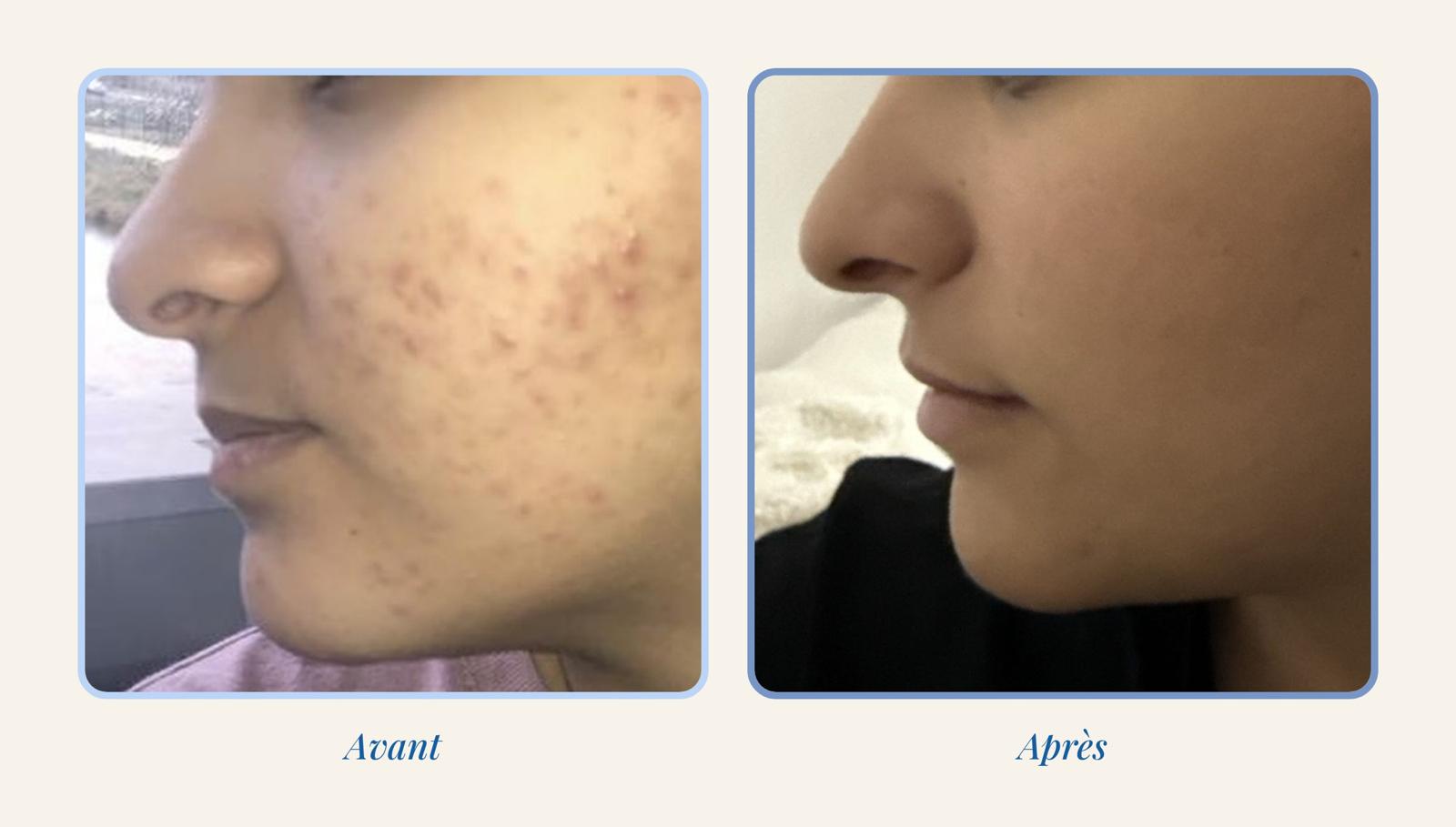 Avant / Après KLYN Care